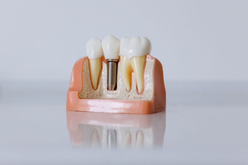 Straumann Implant Turkey: Procedures, Prices, Facts and Advantages